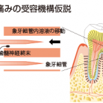 知覚過敏