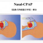 睡眠時無呼吸症候群