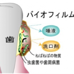 虫歯予防について