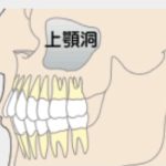上顎洞炎
