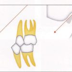 「 歯を守るための力のコントロール Ⅷ 」