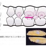 歯を守るための力のコントロール　Ⅸ