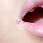 口角炎と口唇ヘルペス