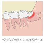 親知らずについて