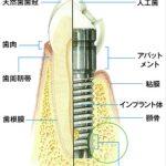 インプラント治療