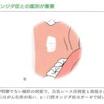 口腔扁平苔癬について