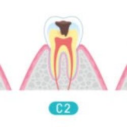 虫歯の種類と治療について